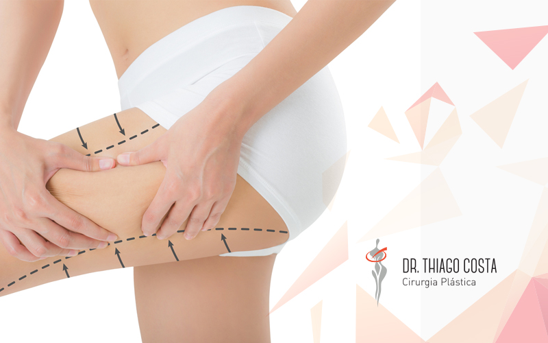 Cruroplastia, uma alternativa para ter pernas mais definidas