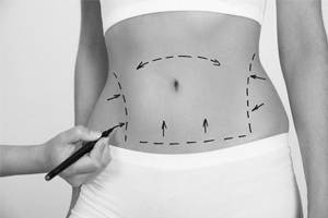 Abdominoplastia ajuda a garantir o abdÃ´men ideal quando exercÃ­cios e dieta nÃ£o funcionam